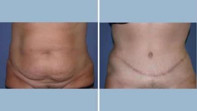 why-nyc-women-are-turning-to-tummy-tucks